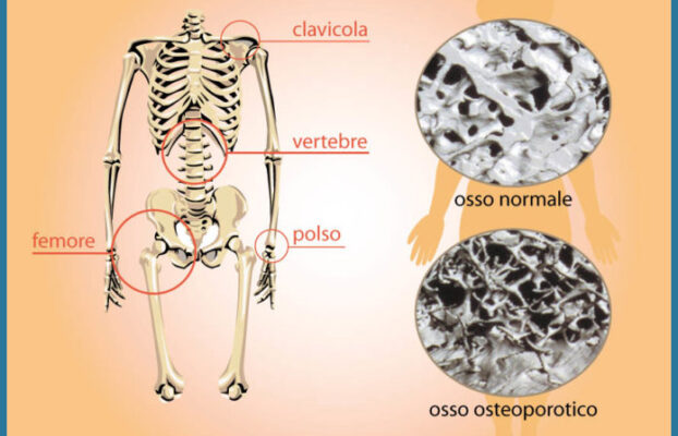 Come convivere con l’osteoporosi