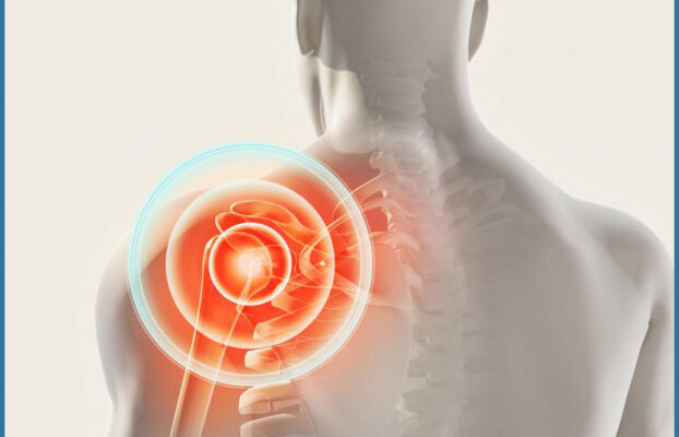 Le domande più frequenti dopo la ricostruzione della cuffia della spalla