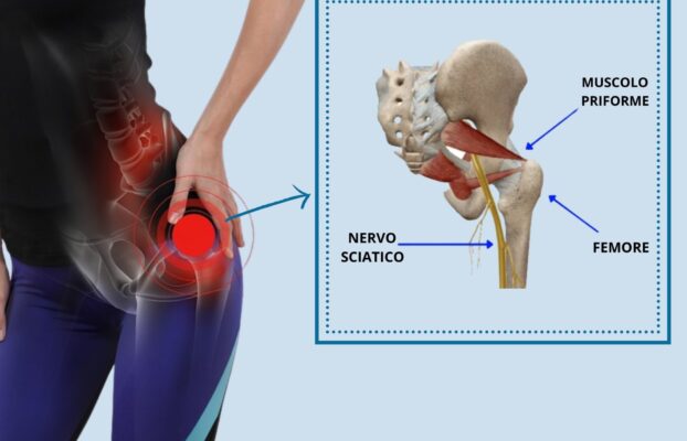 Sindrome del piriforme: cos’è e come riconoscerla
